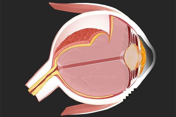 视网膜脱落怎么办_视网膜脱落能治好吗_导致视网膜脱落的原因有哪些？推荐分类