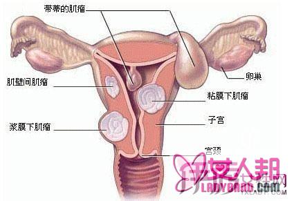 子宫肌瘤的饮食调理要怎么做 饮食调理掌握三项原则