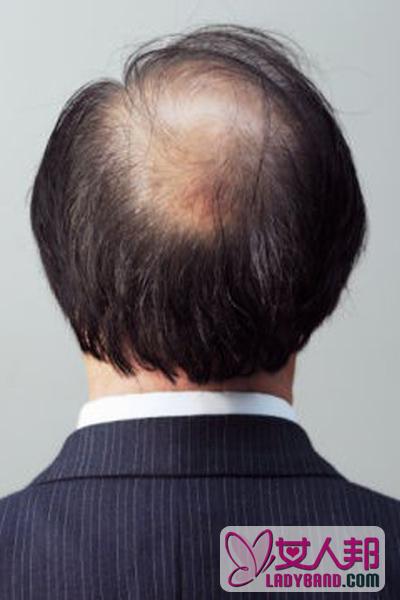 导致男人脱发的原因有哪些 其表现症状是什么