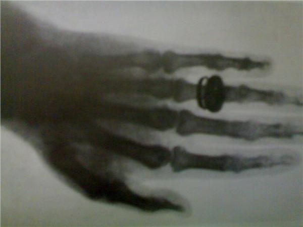 >伦琴发现x射线 1923年2月10日 X射线的发现者伦琴逝世