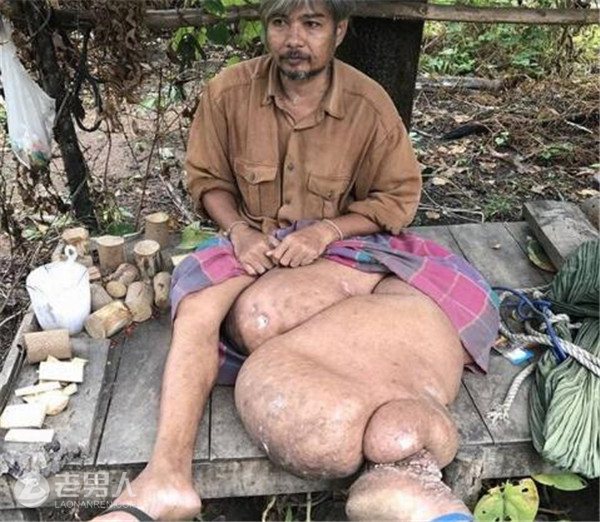 泰国男子长出象腿 患淋巴腺炎十年导致左腿肿胀