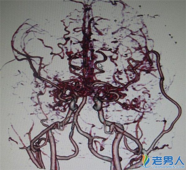 >烟雾病病因治疗方法介绍 患者饮食需要注意什么